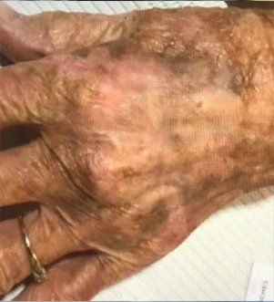 Left Dorsal Hand