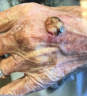 Left Dorsal Hand