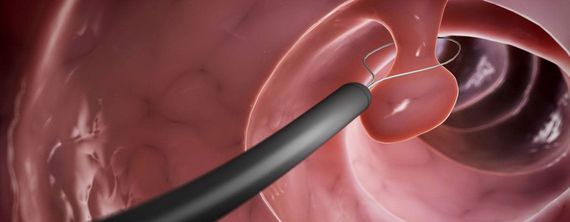 ENDOSCOPÍA