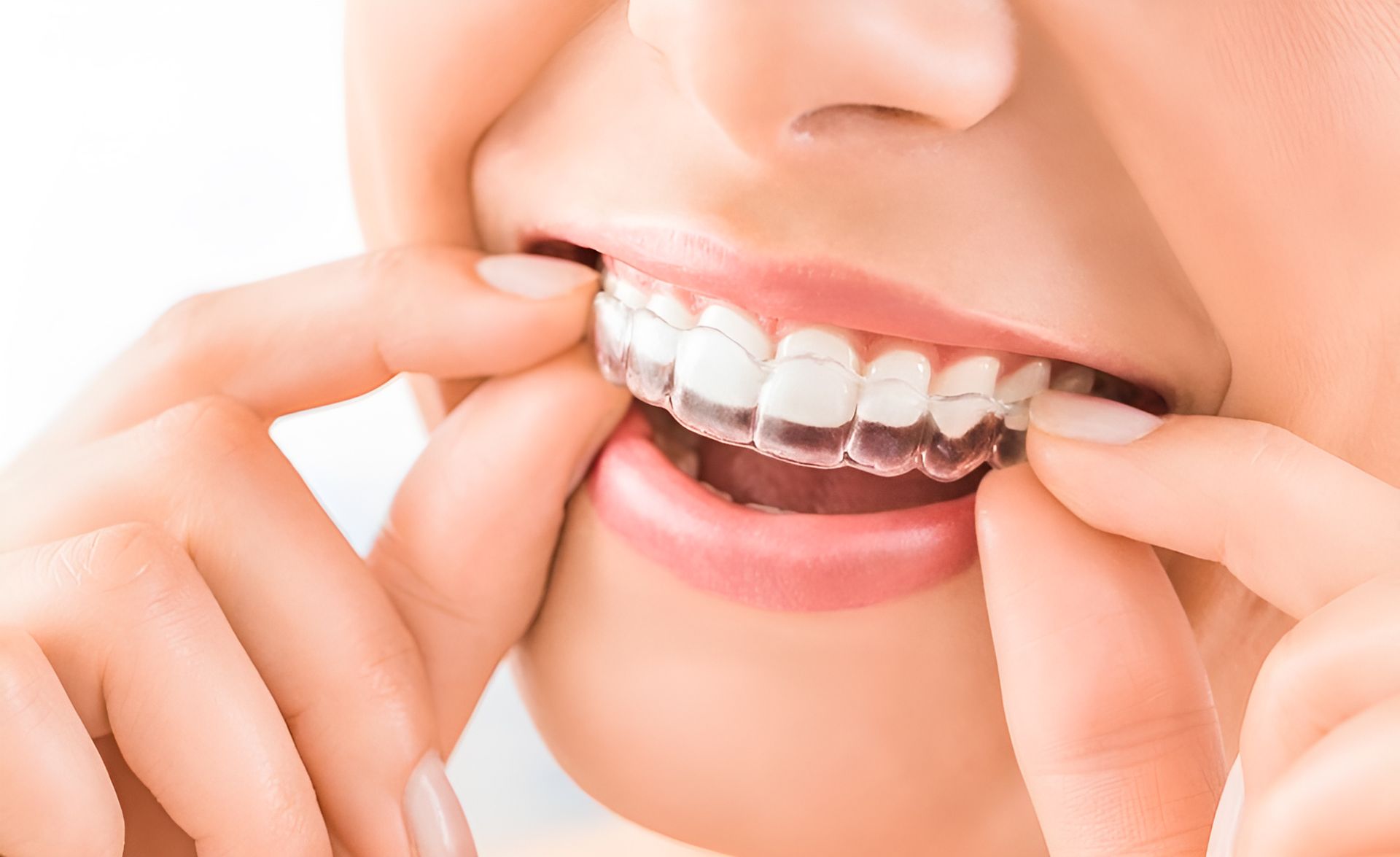 A Woman placing her Invisalign in her mouth — St Ives Dental Boutique In Saint Ives, NSW