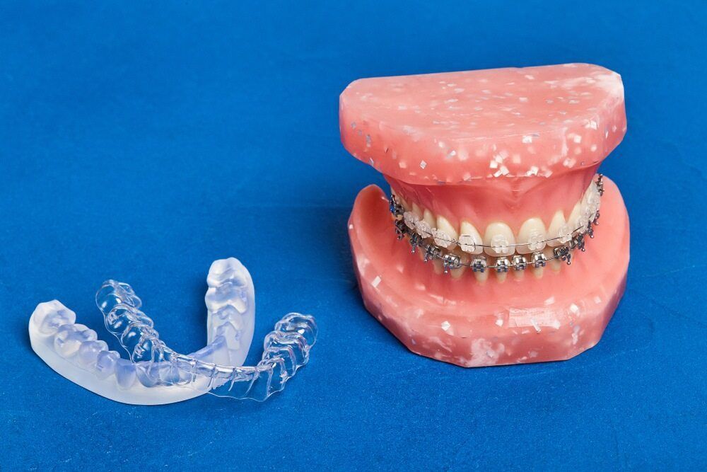 A Model Of A Mouth With Braces And A Clear Retainer — St Ives Dental Boutique In Saint Ives, NSW