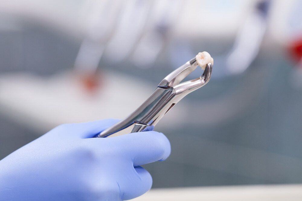 A Dentist Is Holding A Pair Of Dental Pliers With A Tooth In It — St Ives Dental Boutique In Saint Ives, NSW