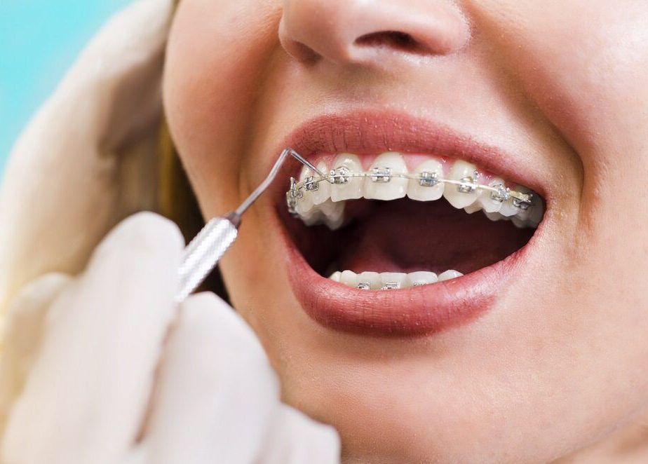 A Woman With Braces Is Getting Her Teeth Examined By A Dentist — St Ives Dental Boutique In Saint Ives, NSW