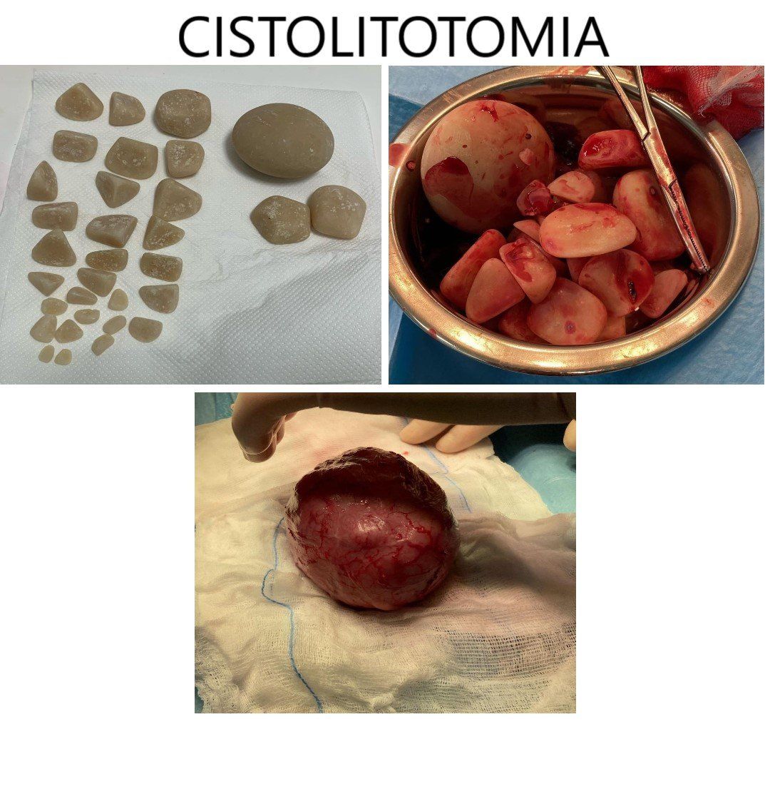 cistolitotomia