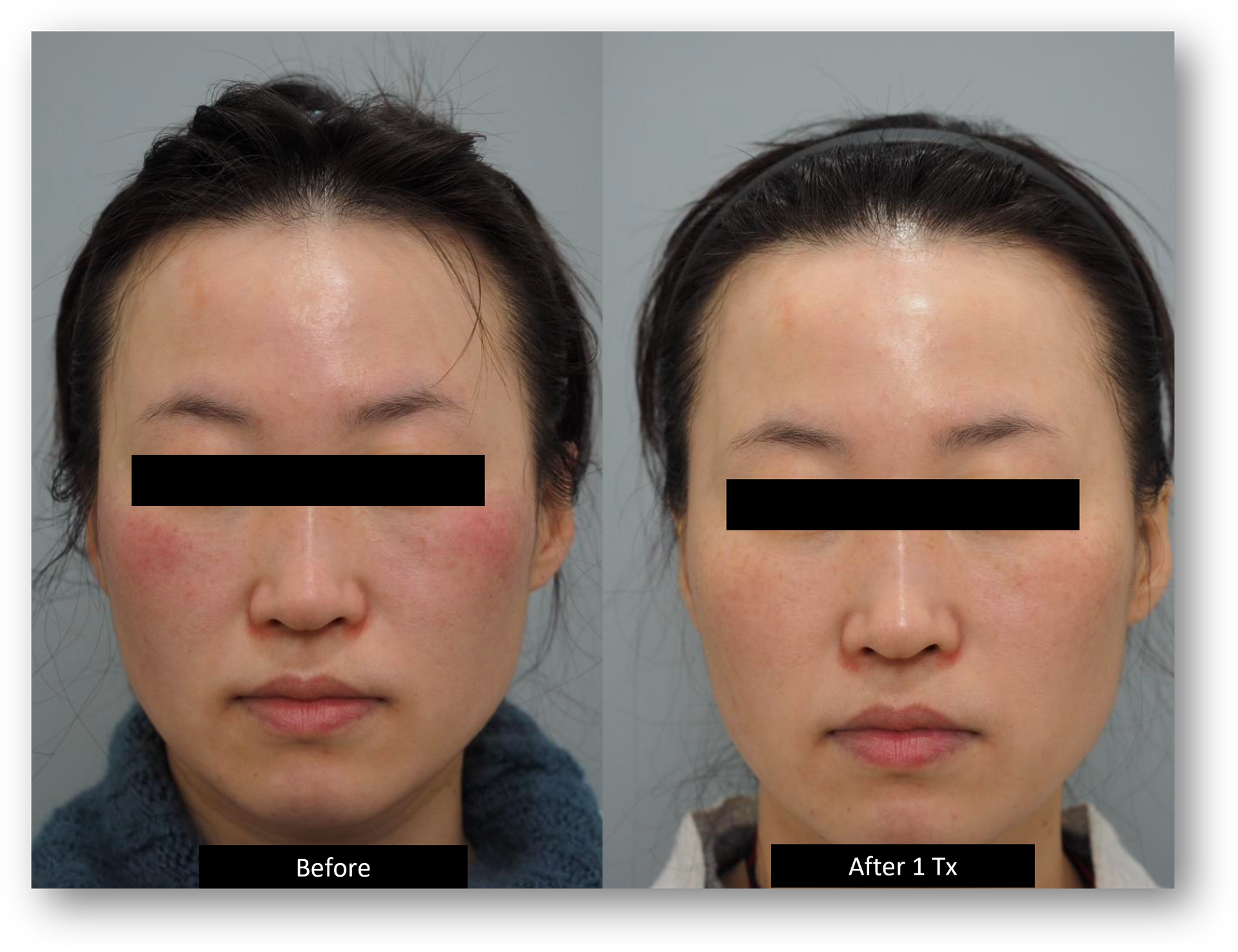 Side-by-side portrait comparison of a woman's face labeled before and after treatment.