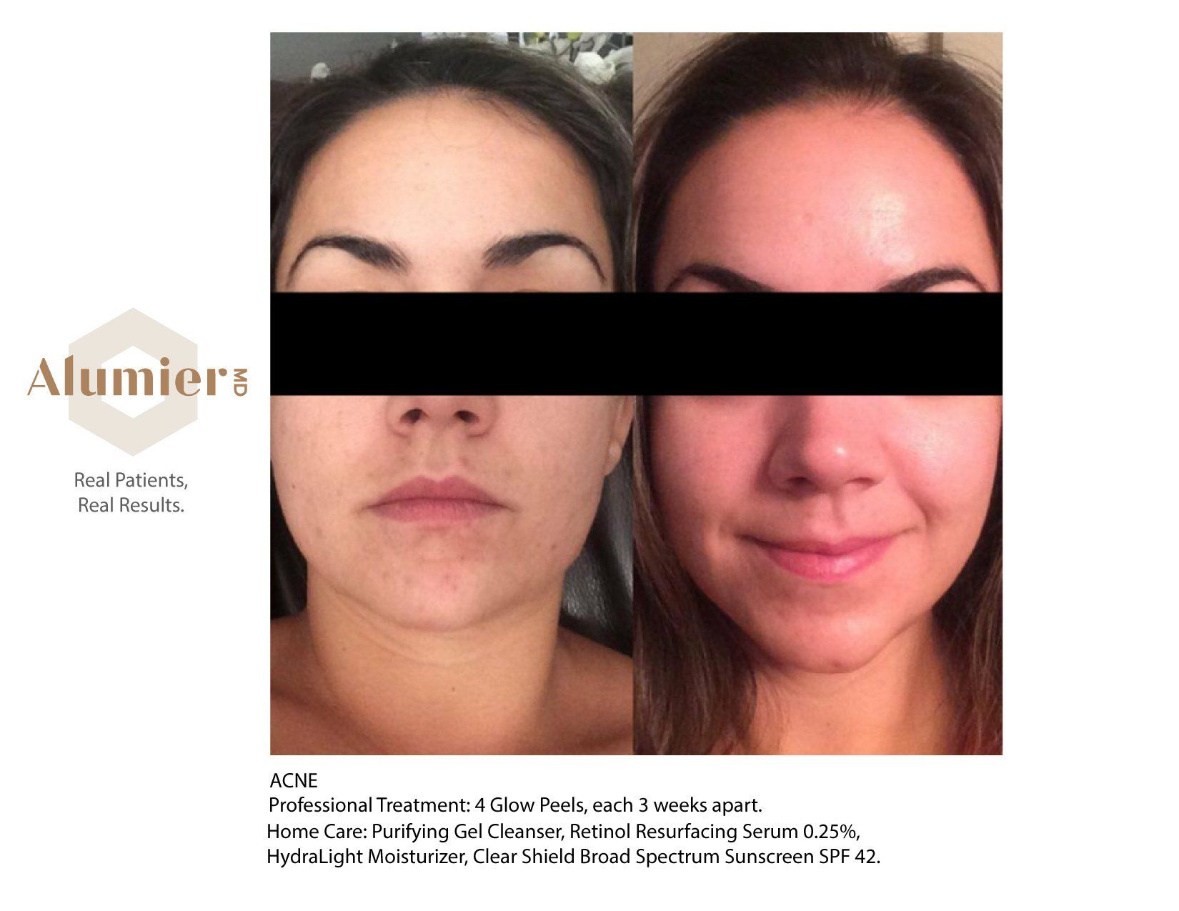 A before and after photo of a woman 's face