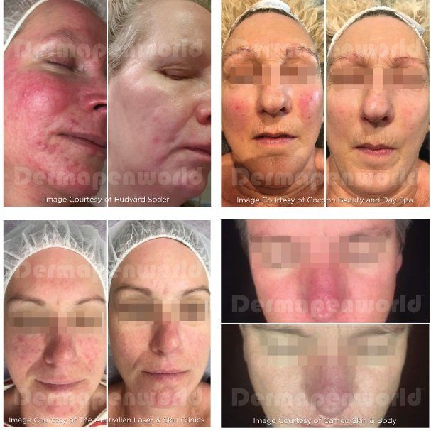 A before and after photo of a woman 's face