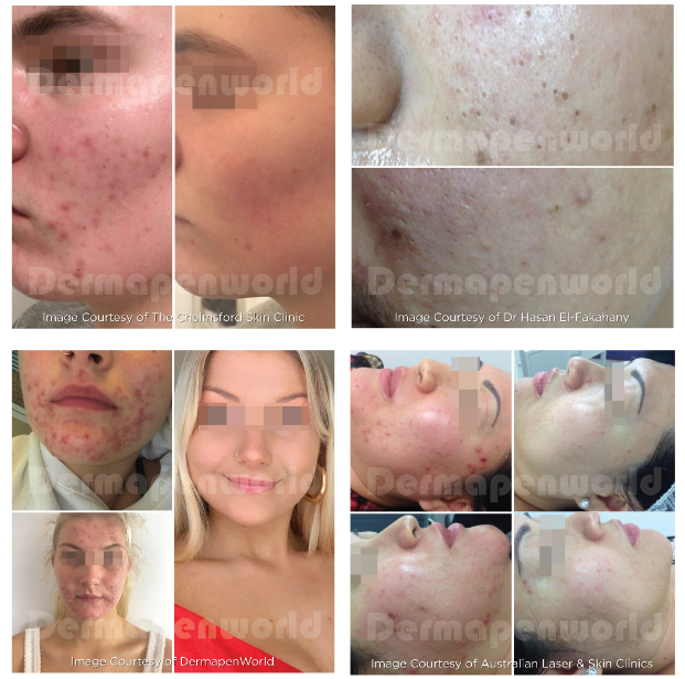 A collage of images of a woman 's face with the words dermapenworld on the bottom