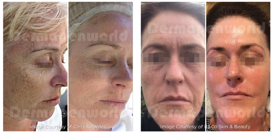 A woman 's face is shown before and after a treatment.