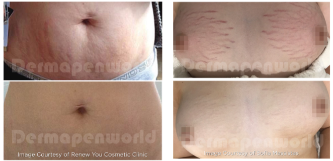 A collage of four pictures of a woman 's stomach with stretch marks