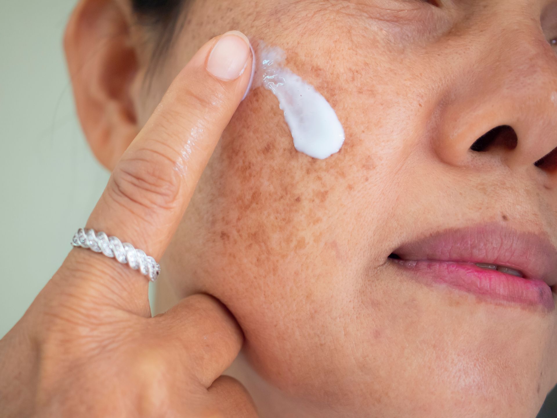 A person applying a dab of white skincare cream to their cheek, which has noticeable areas of hyperpigmentation.