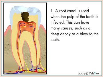 Root Canal — Plymouth, MI — Leslie M Woodell DDS
