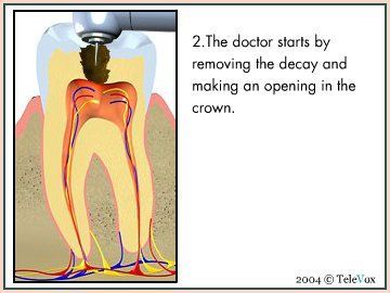 Removing Tooth Decay — Plymouth, MI — Leslie M Woodell DDS