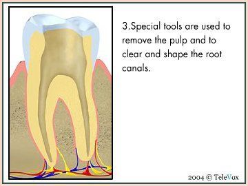 Cleared Root Canal — Plymouth, MI — Leslie M Woodell DDS