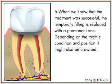 Replacing Temporary Filling — Plymouth, MI — Leslie M Woodell DDS