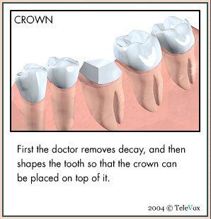 Placing Crown — Plymouth, MI — Leslie M Woodell DDS