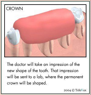 Dental Impression — Plymouth, MI — Leslie M Woodell DDS