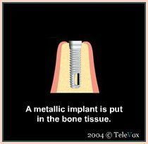 Bone Tissue Of Tooth — Plymouth, MI — Leslie M Woodell DDS
