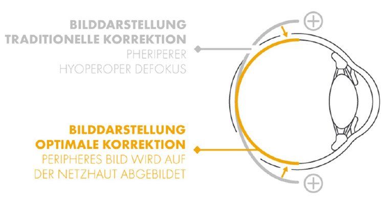 Peripherer Defokus