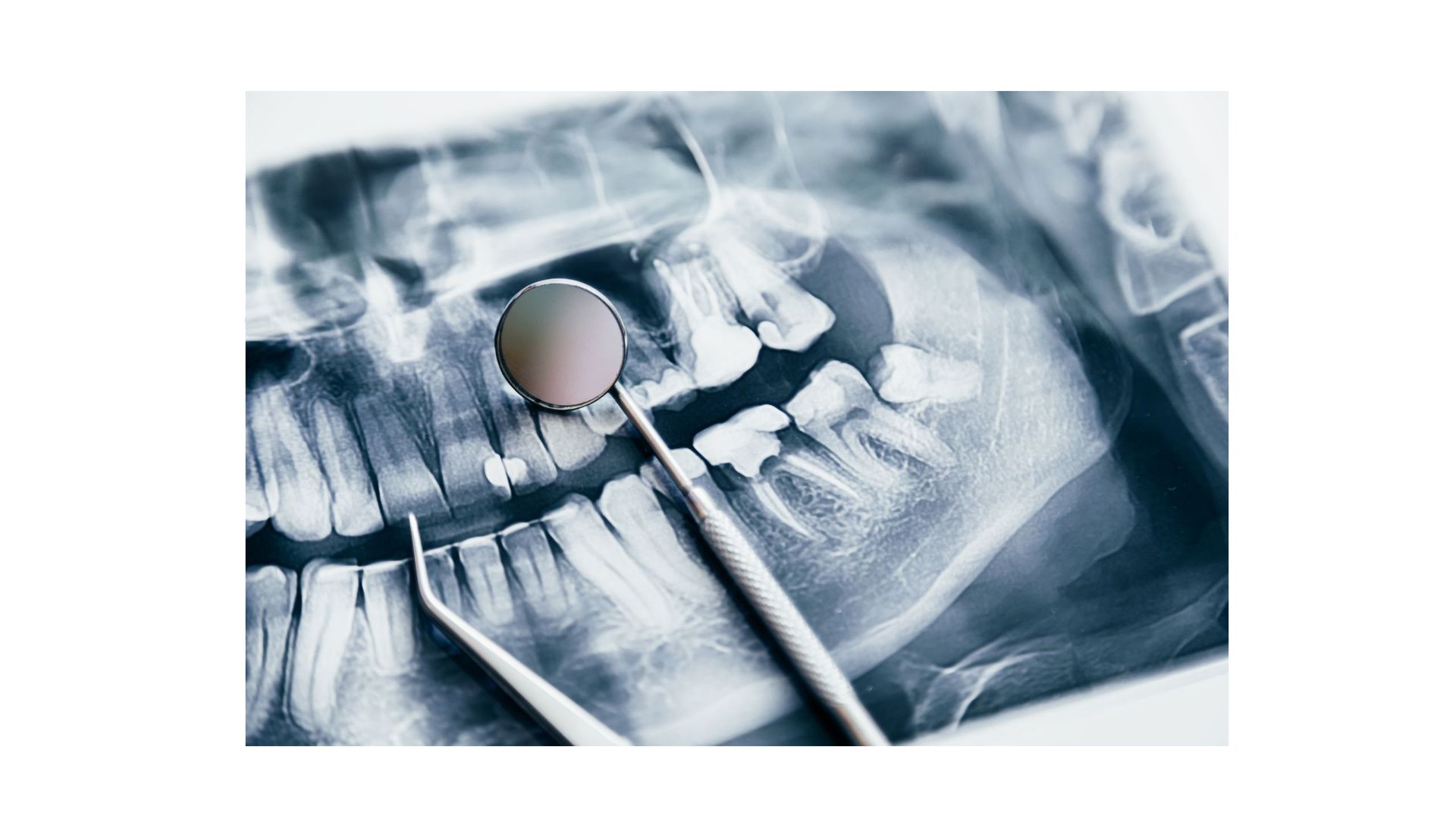 An x-ray of a person 's teeth with a dental mirror.