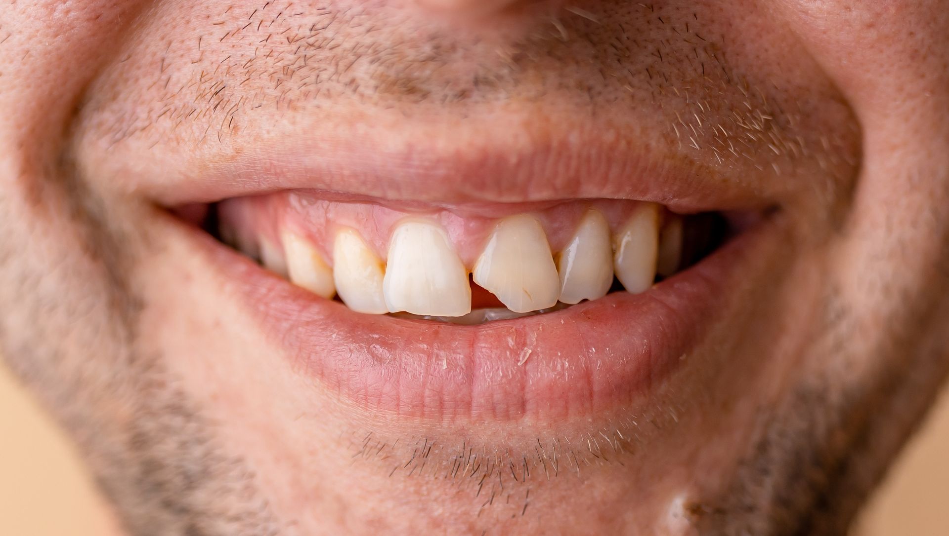 Close-up of a smiling mouth with slightly crooked teeth and light facial stubble.
