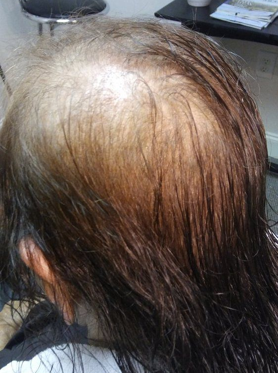 Cancer Hair Loss Replacement in Alpharetta, GA Cancer Hair Loss Replacement in Alpharetta, GA