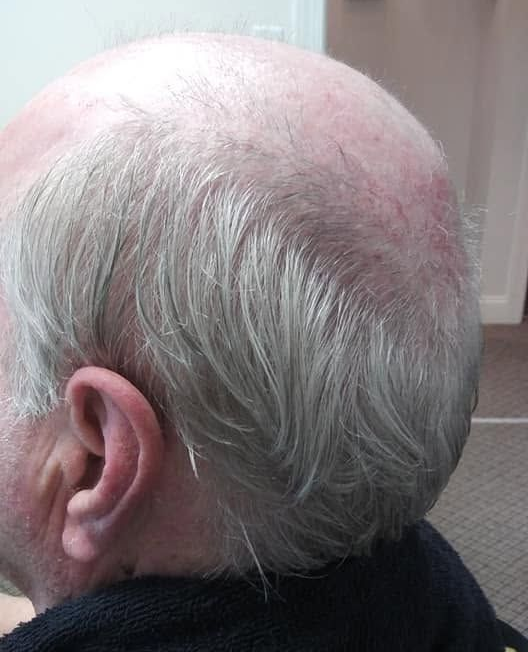 Custom Hair Replacement in Alpharetta, GA