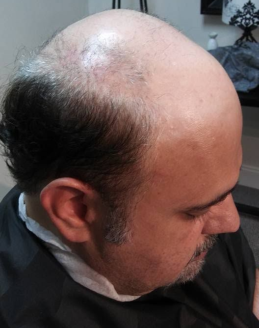 Hair Replacement Service in Alpharetta, GA Hair Replacement Service in Alpharetta, GA