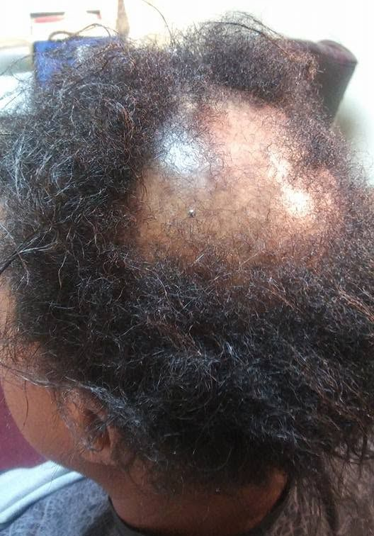Trichotillomania Hair Loss Replacement in Alpharetta, GA