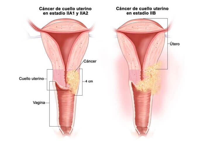 DRA. MARÍA DE LOS ÁNGELES CROSTHWAITE - CANCER UTERINO