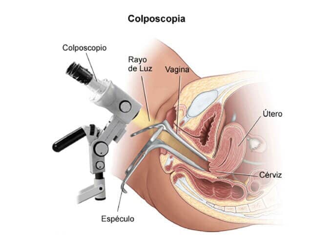 DRA. MARÍA DE LOS ÁNGELES CROSTHWAITE -  COLPOSCOPIA