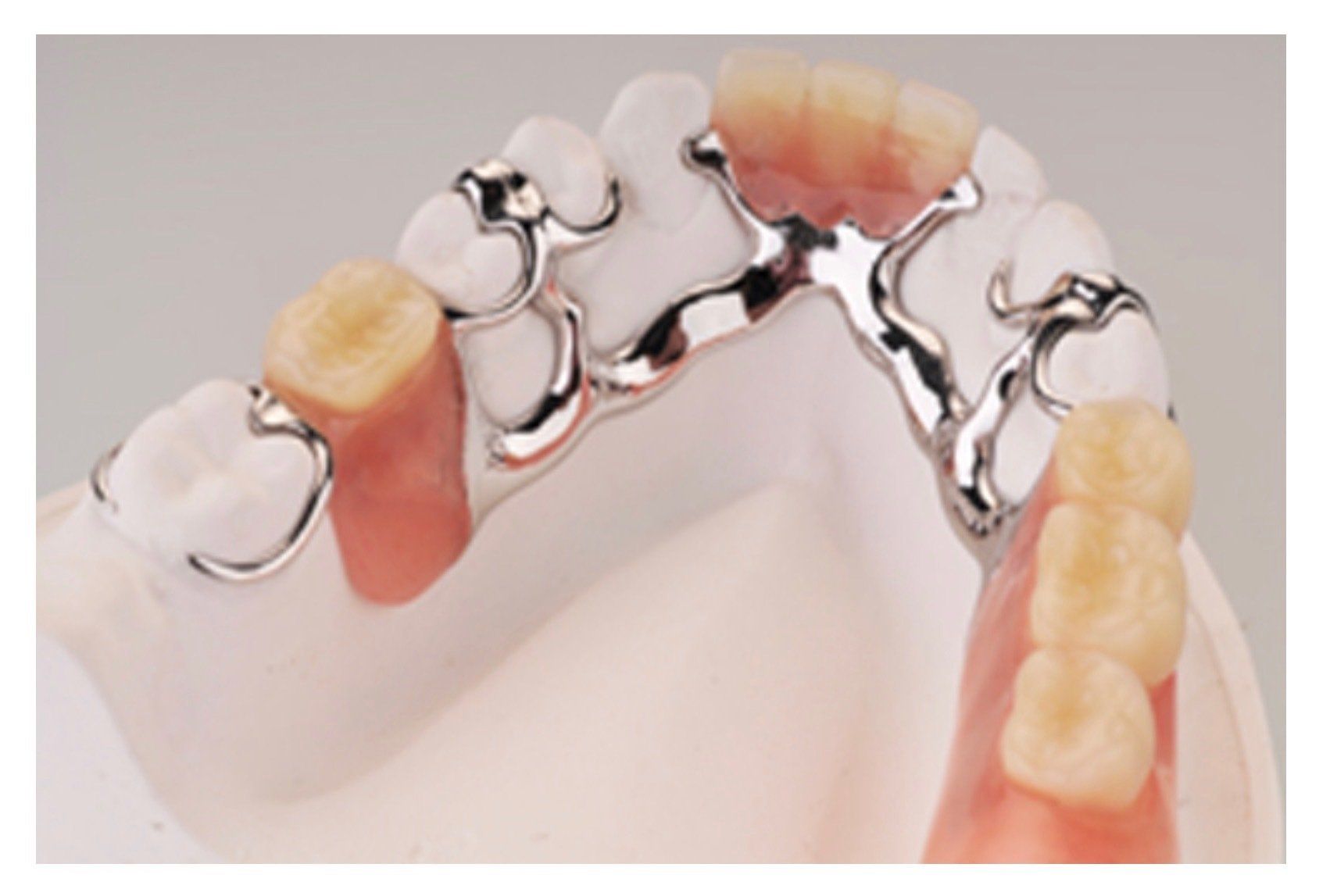 Dental partial denture with metal clasps and pink artificial gums on a white model