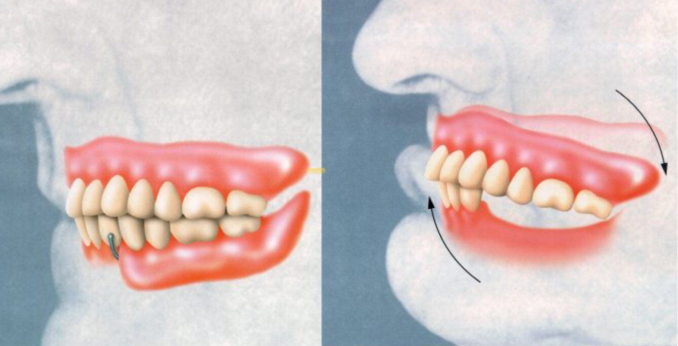 Flippers Illustration Side-view dental diagram showing teeth alignment and jaw position, with one normal and one protruding profile.