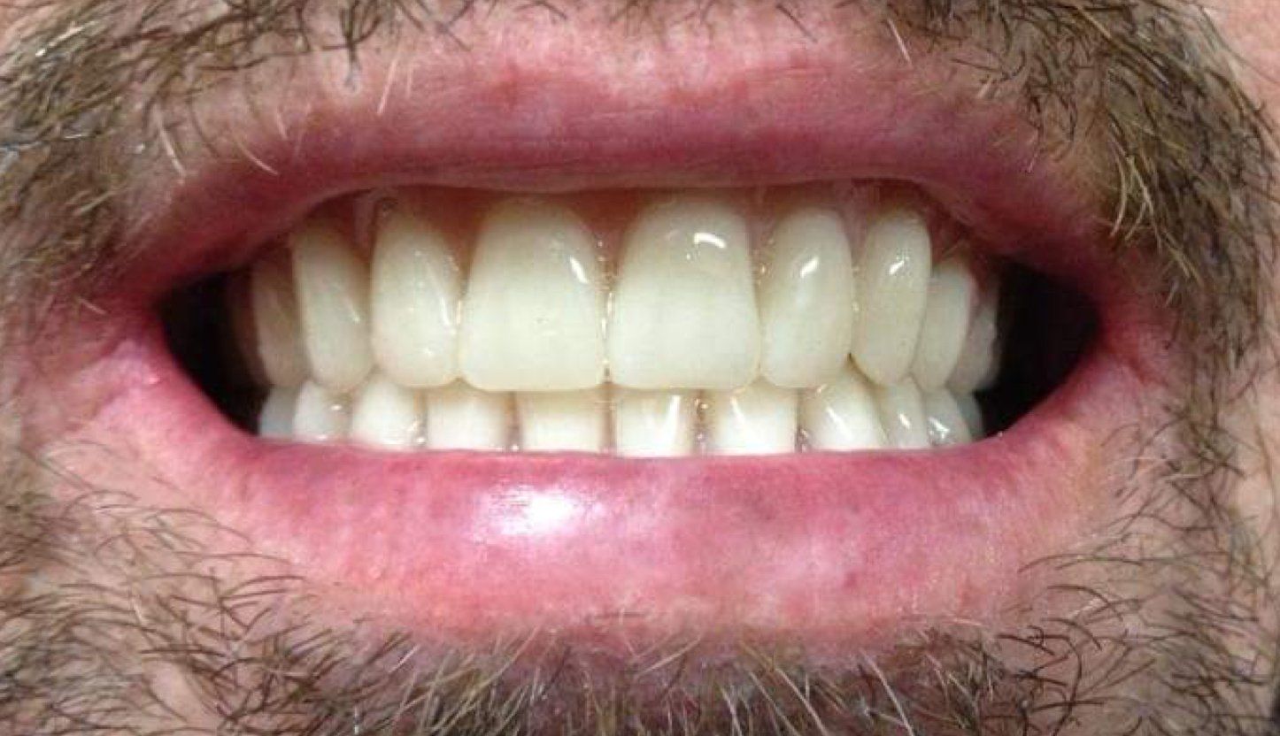 Close-up of a smiling mouth showing white teeth and pink lips with facial hair around it