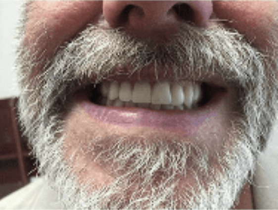 Close-up of a smiling mouth with a gray beard and mustache, showing teeth