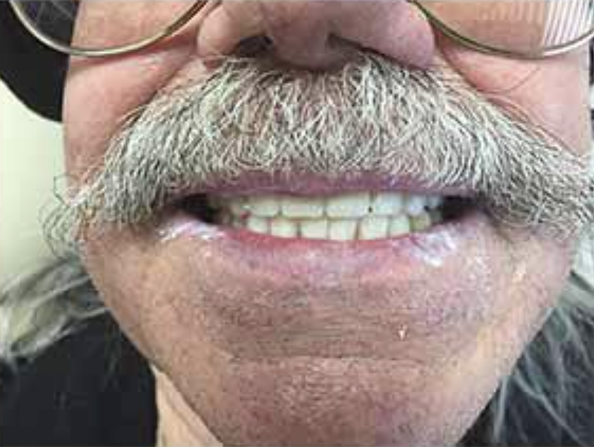 Close-up of a smiling mouth with mustache, missing front tooth, and glasses visible above the nose