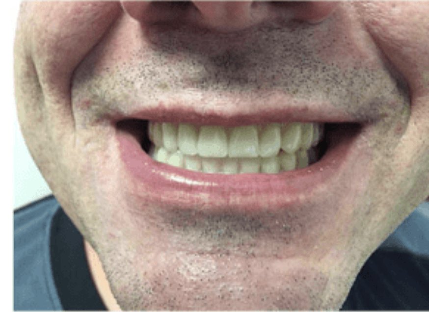Close-up of a smiling mouth with visible teeth and light facial stubble