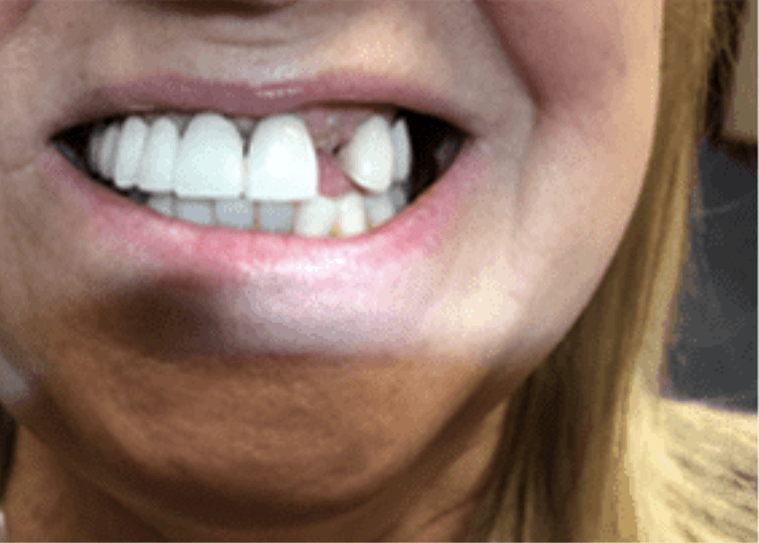 Close-up of a smiling mouth showing white teeth, with one upper front tooth missing.