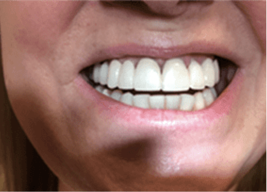 Close-up of a smiling mouth showing bright white teeth and lips