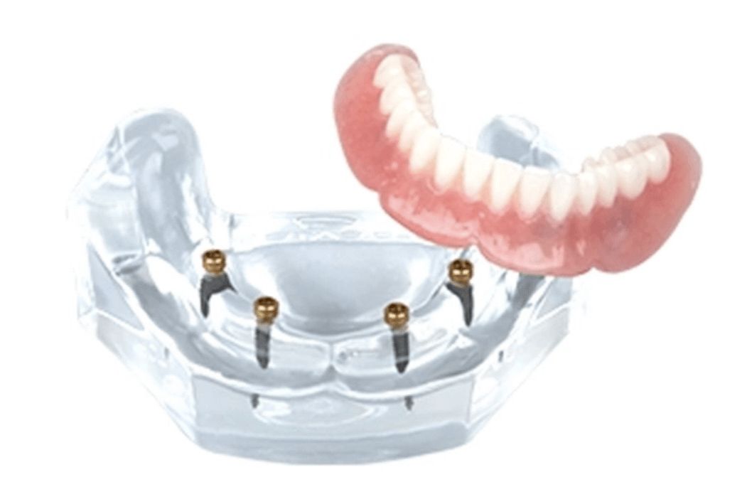 Dental implant model with clear gum base and pink dentures floating above it