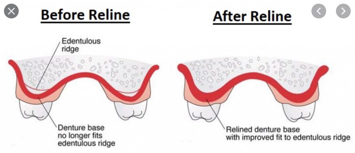 Repairs and Relines Before and after diagram of denture reline showing improved fit on gums after ridge changes