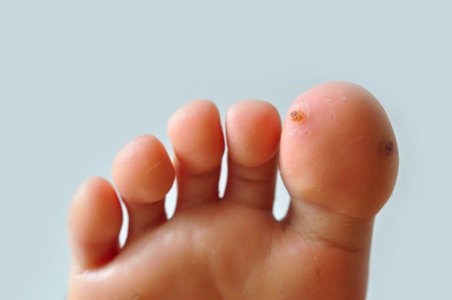 wart on child's big toe