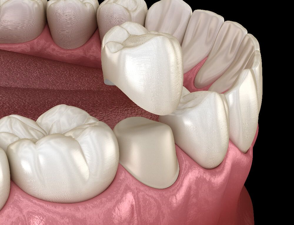 Naperville dental crown