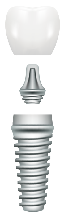 dental implant Naperville