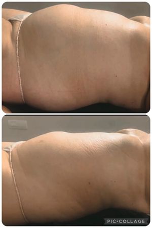 Due foto affiancate del busto di una persona. La parte superiore mostra una forma più piena; quella inferiore, un contorno meno arrotondato.