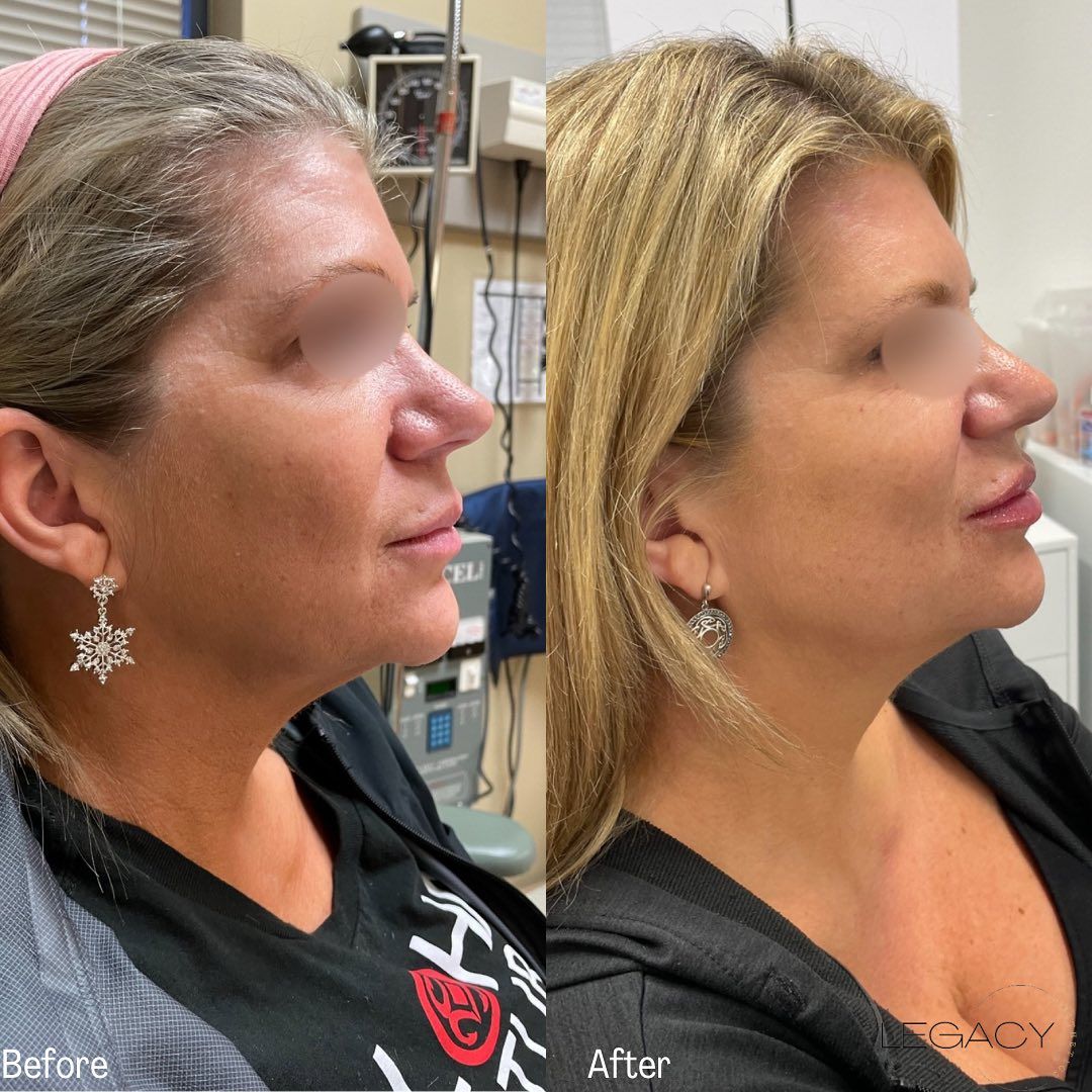 Side-by-side before and after profile photos of a woman with a lifted cheek and nose contour.