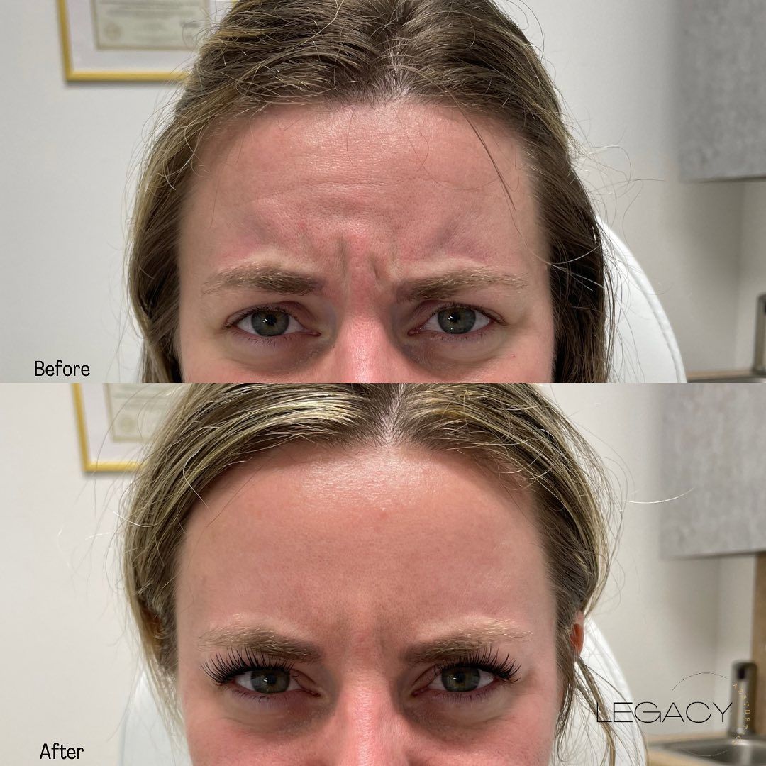 Before-and-after close-up of a forehead with reduced frown lines after treatment