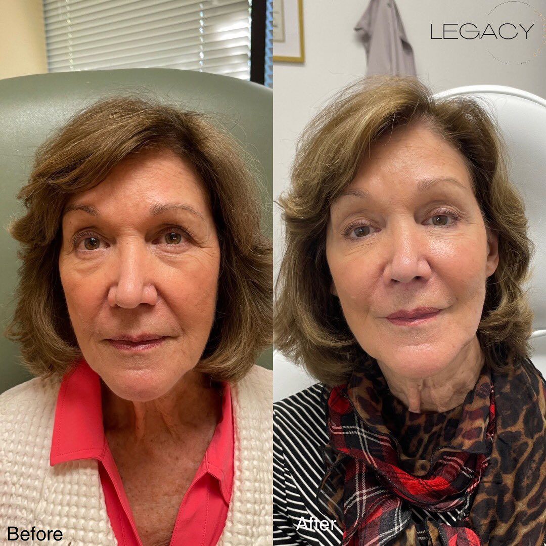 Side-by-side before-and-after portrait of a woman, one in a pink blouse and the other in a scarf.