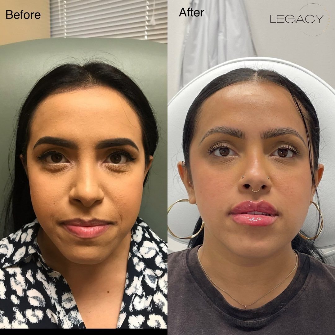 Before-and-after face comparison: natural makeup on left, fuller lips and brighter complexion on right.