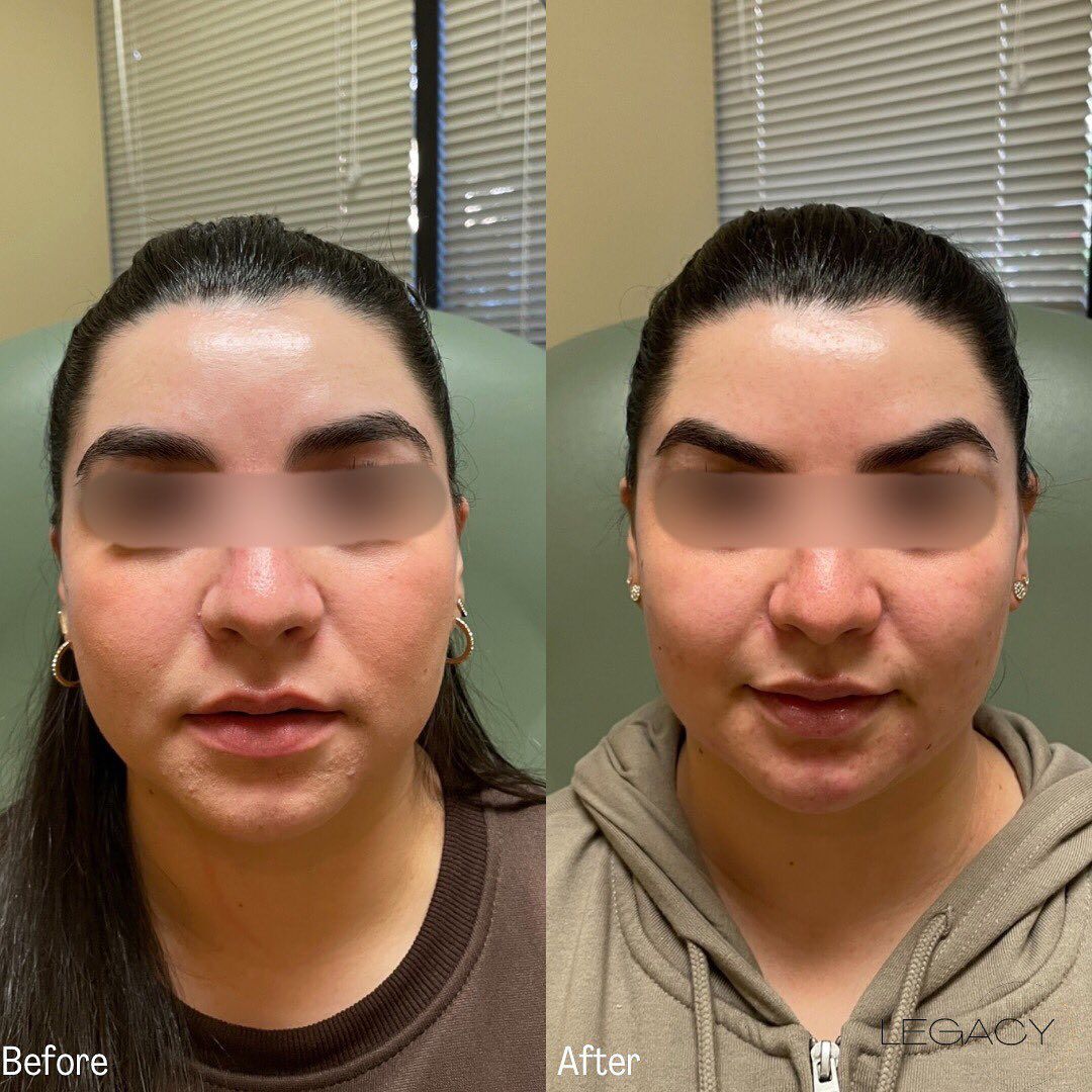 Side-by-side before-and-after face comparison; the right image shows more defined eyebrows and a fuller smile.